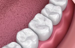 dental fillings in Kingwood, TX