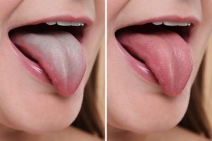 before and after tongue cleaning