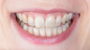 tooth enamel erosion 