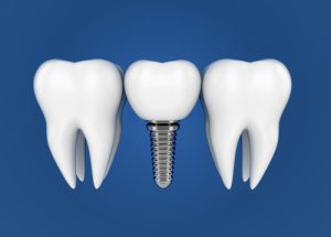 image of dental implant