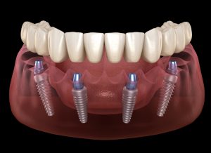 implant-supported dentures