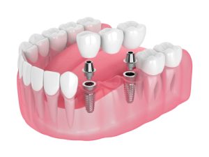 implant-supported bridge