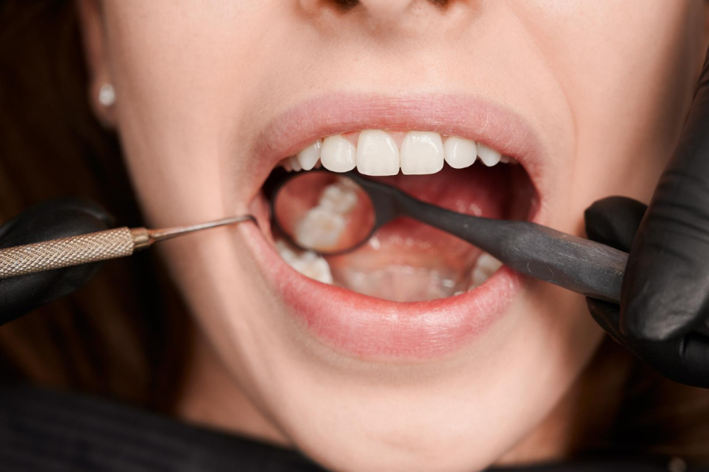 Dental Fillings procedure